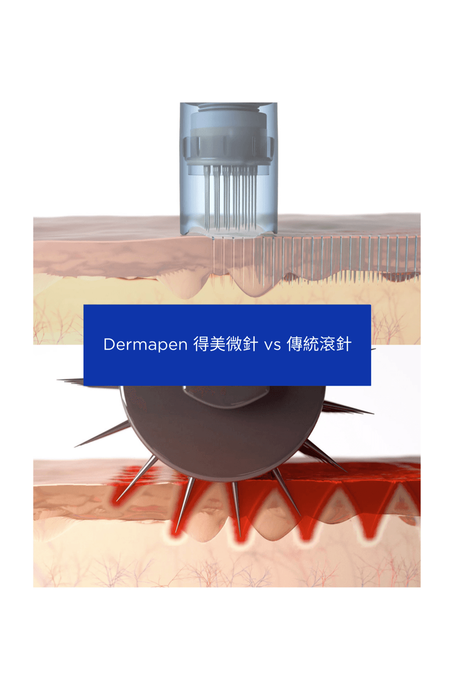 電動微針筆與傳統滾輪式微針的進針方式對照示意圖