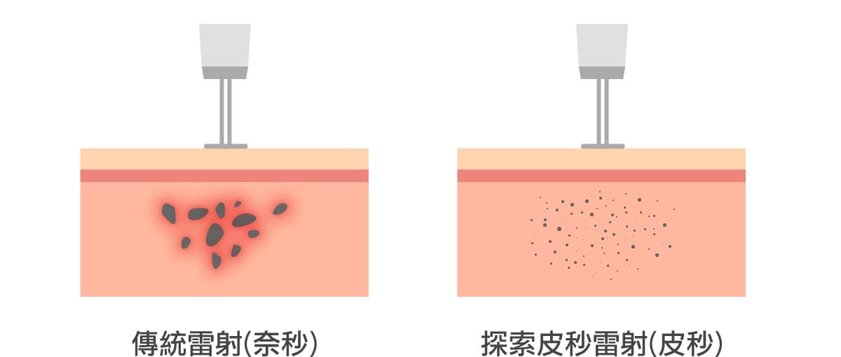 傳統奈秒雷射與皮秒雷射的作用機制示意圖
