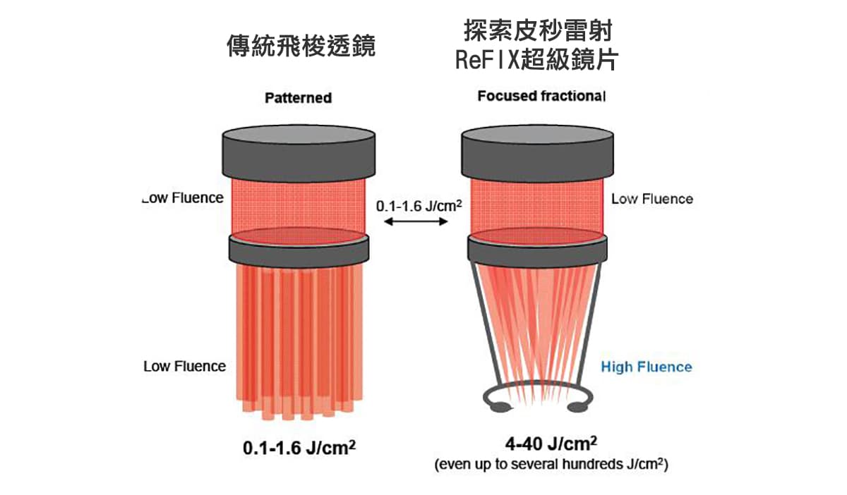 ReFIX 聚焦鏡片與傳統飛梭透鏡能量密度比較示意圖