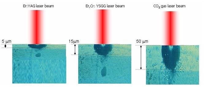 鉺雅克、Er,Cr:YSGG 與二氧化碳雷射的單發剝離深度對照