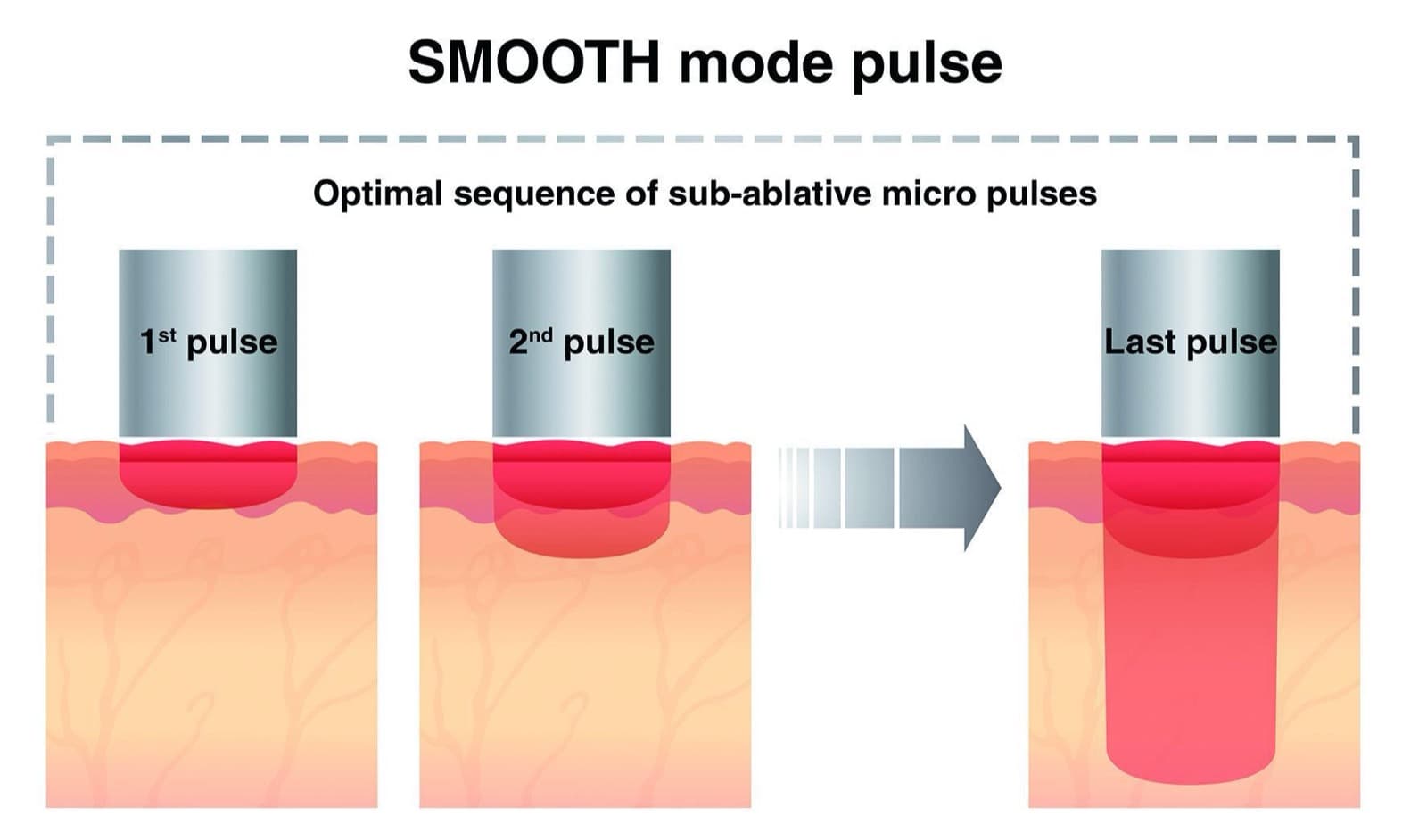 SMOOTH Mode 次脈衝疊加加熱示意圖(1st pulse、2nd pulse 到 last pulse 的溫和加熱序列)