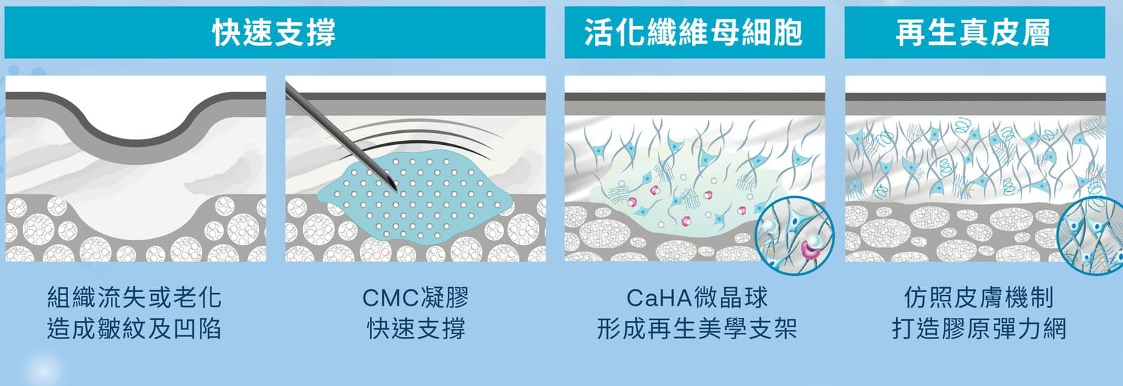 作用機轉示意:組織流失造成皺紋凹陷、CMC 凝膠快速支撐、CaHA 微晶球形成支架、仿照皮膚機制打造膠原彈力網